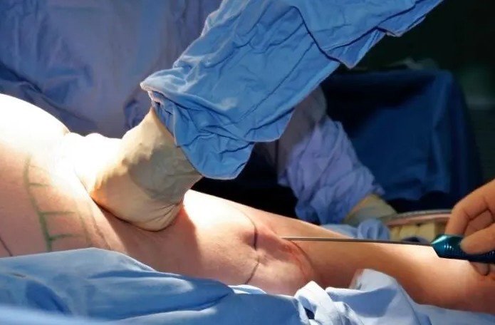 Best Liposuction Surgery in Delhi