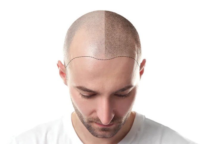 Best Hair Transplantation Surgery in East Delhi