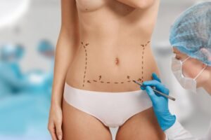 Best Liposuction Treatment in Delhi NCR