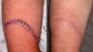 Best Tattoo Removal Surgeon in Delhi NCR