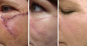 Best Scar Revision Surgeon in Delhi