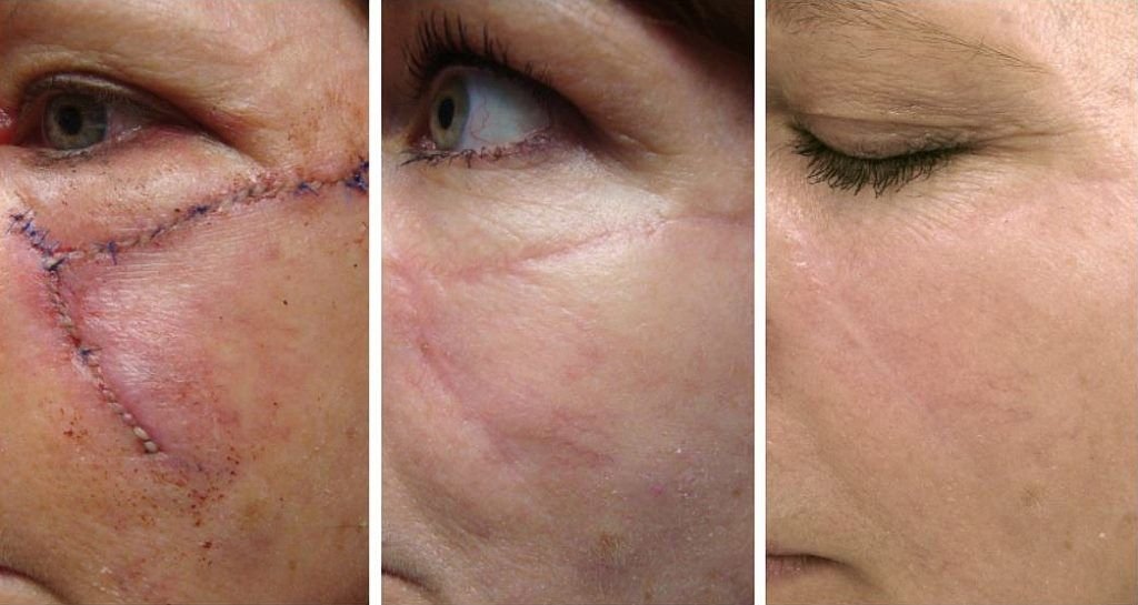 Best Scar Revision Surgeon in Delhi