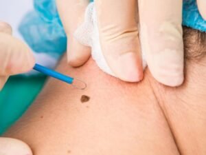 Best Mole and Cyst Removal in Delhi NCR