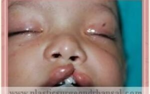 Birth Defects Treatment in Delhi NCR