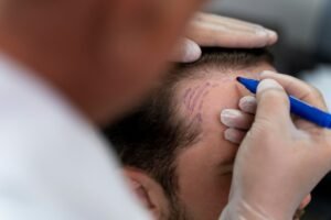 Hair Transplant in Delhi NCR