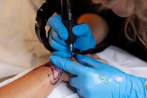 Laser Tattoo Removal in Delhi