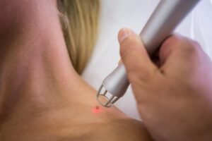 Mole Removal in East Delhi