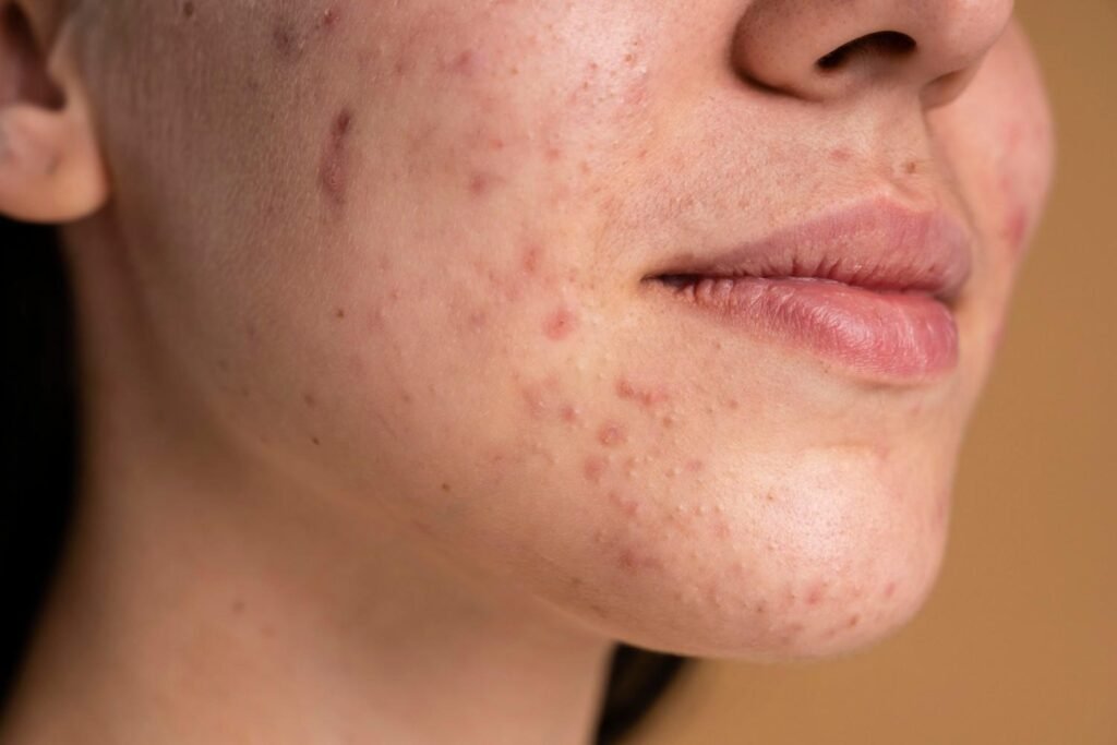 Acne Scar Treatment in Delhi NCR