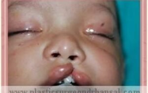 Birth Defects Treatment in Delhi