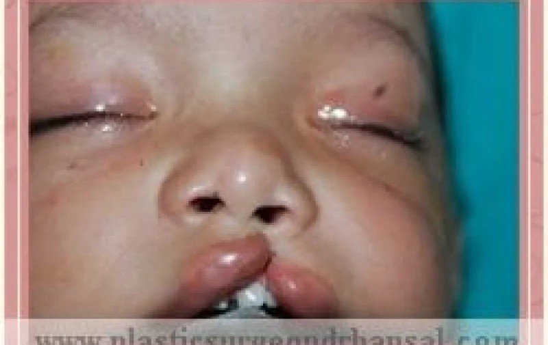 Birth Defects Treatment in Delhi