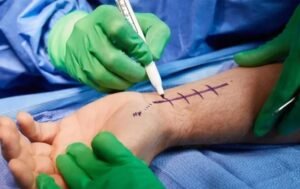 Hand Trauma Surgery in Delhi