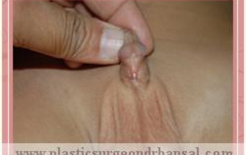 A young child with abnormal opening of urethra