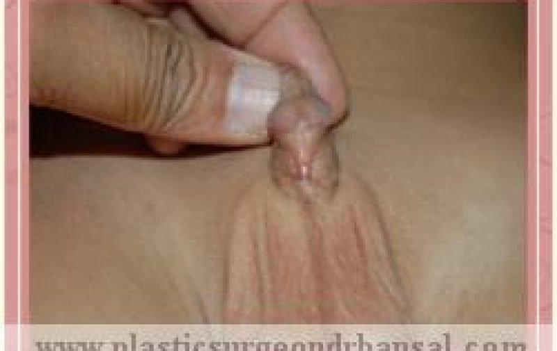 A young child with abnormal opening of urethra