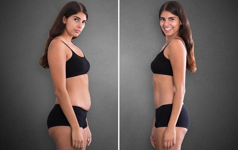 Lipo-HD-in-Los-Angeles