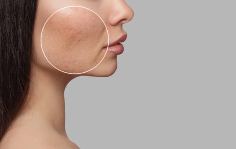 Photo before and after treatment for acne. A young girl with a problem skin. Skin treatments. Cosmetology and professional skin care.