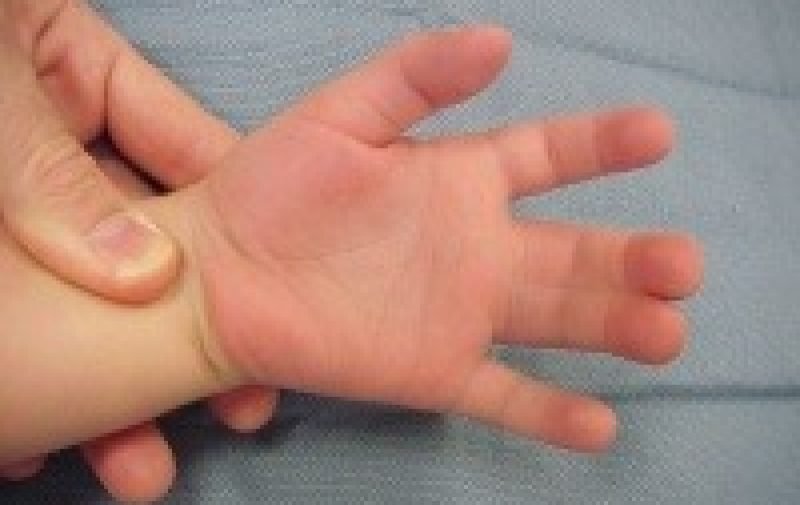 limb-problems-syndactyly-4b
